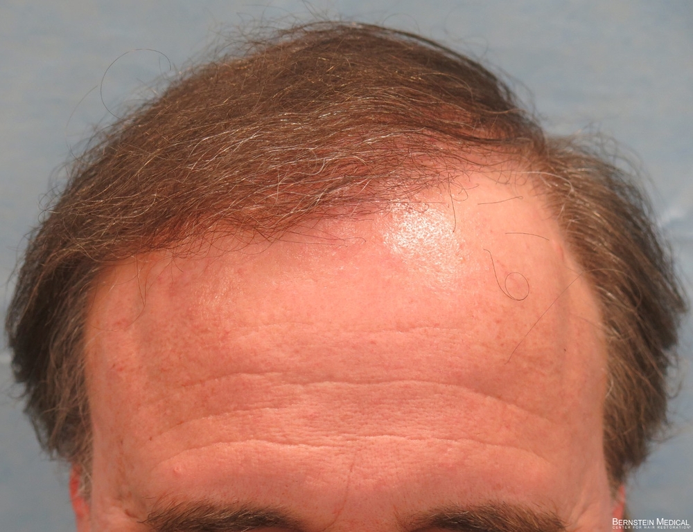 1d_after-hair-transplant_ioi.jpg