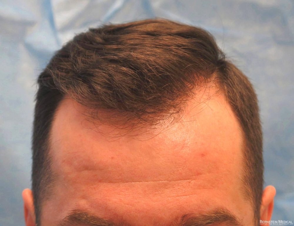 1d_after-hair-transplant_kzk.jpg