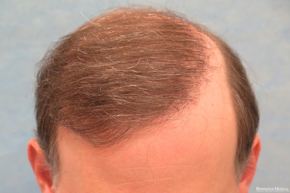 1d_results-after-repair-fut_eti.jpg