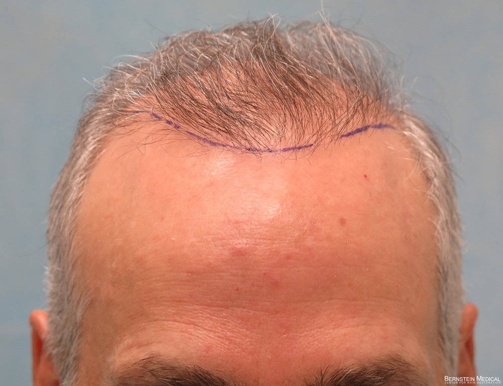 1e-planned-position-of-second-hairline-avz.jpg