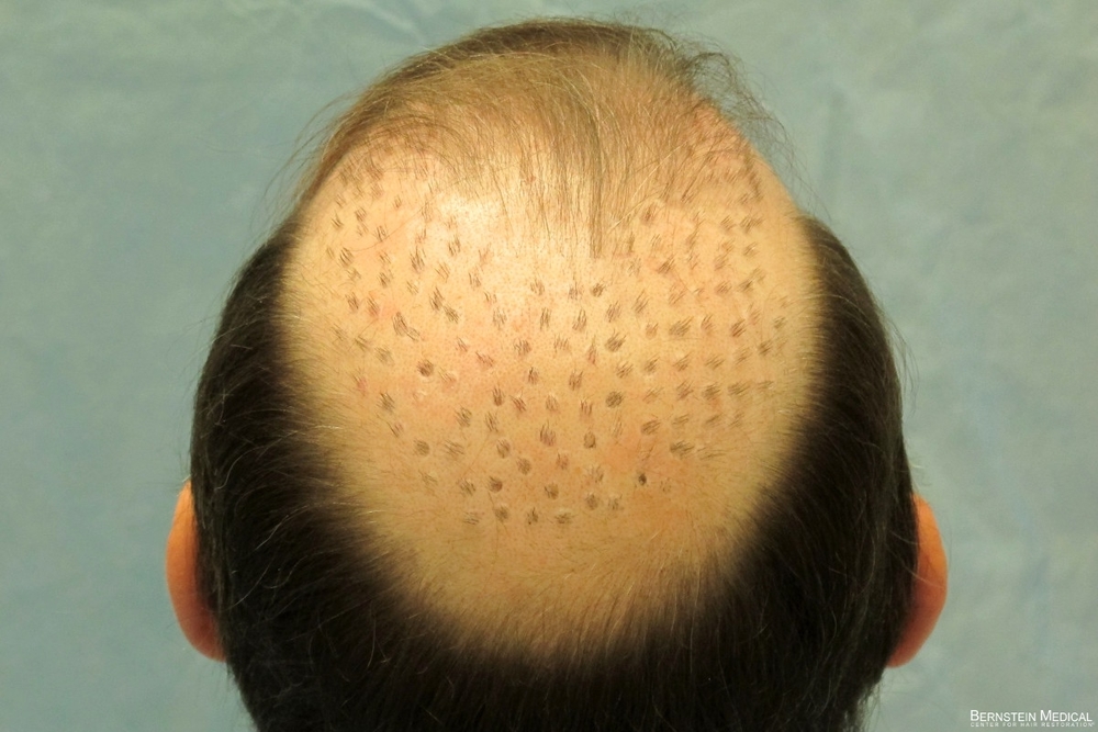 2a_before-graft-excision_eti.jpg