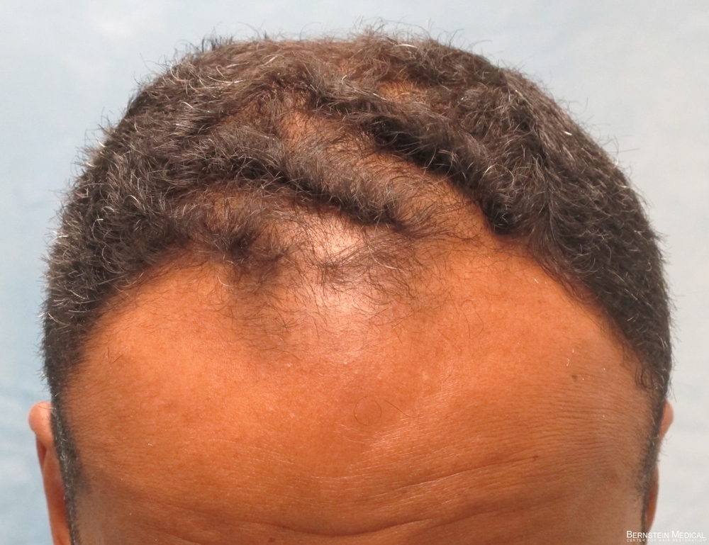 2a_before-hair-transplant_ijc.jpg