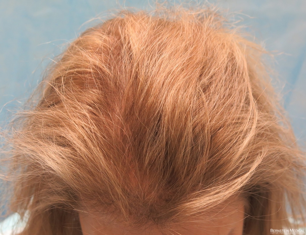 2a_before-transplant-top-view_gbe.jpg