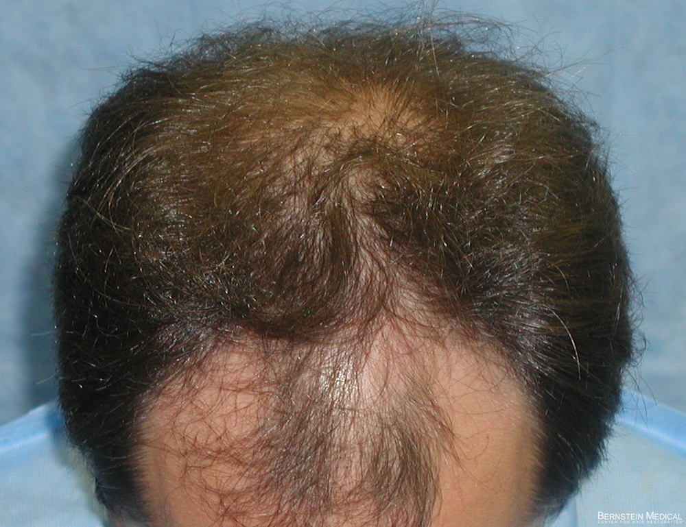 2a_before-transplant-top-view_hyc.jpg