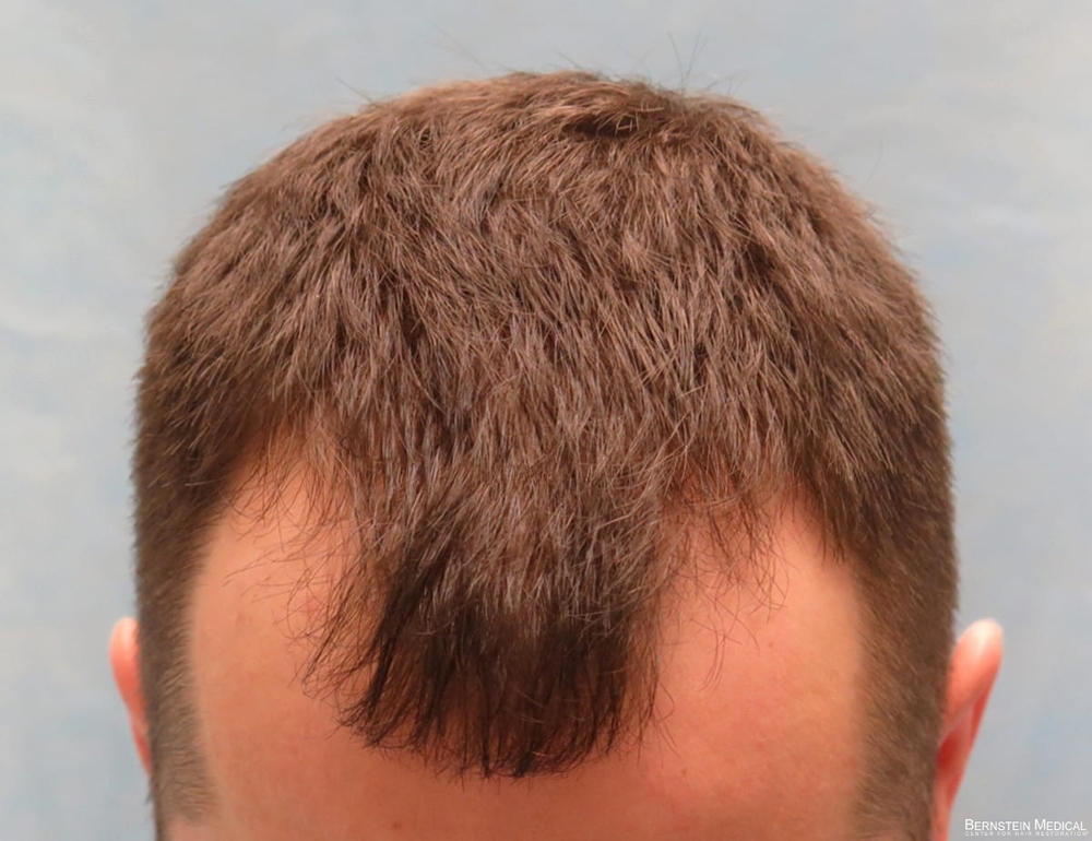 2a_before-transplant-top-view_kzk.jpg