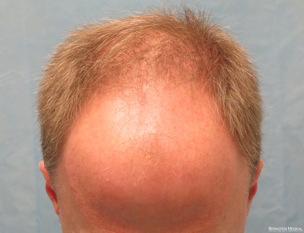 2a_before-transplant-top-view_rfr.jpg