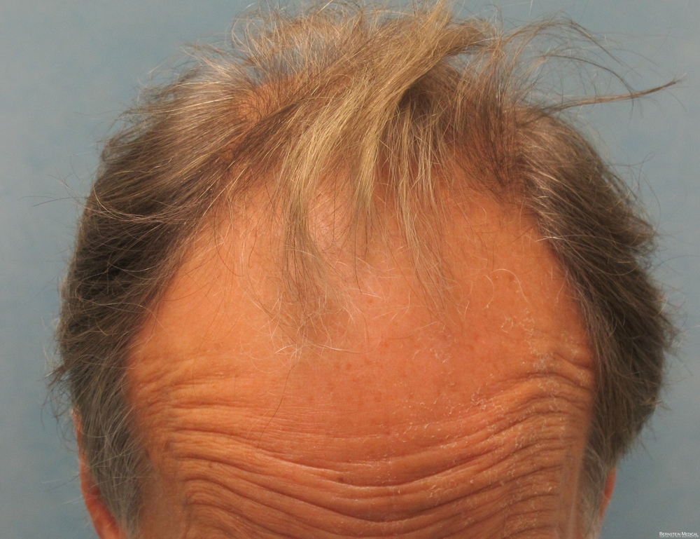 2a_before-transplant-top-view_rir.jpg