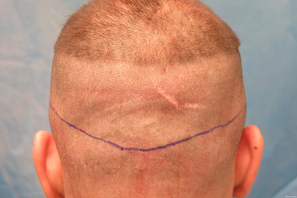 2a_donor-area-with-scar_rsi.jpg