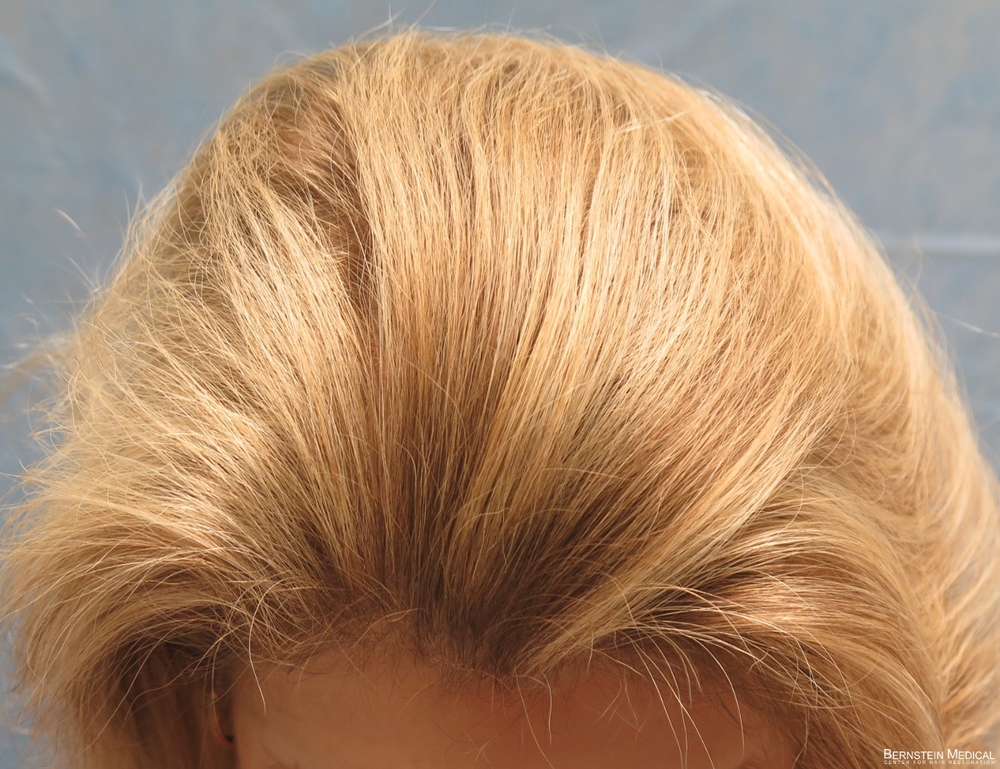 2b_after-transplant-top-view_gbe.jpg