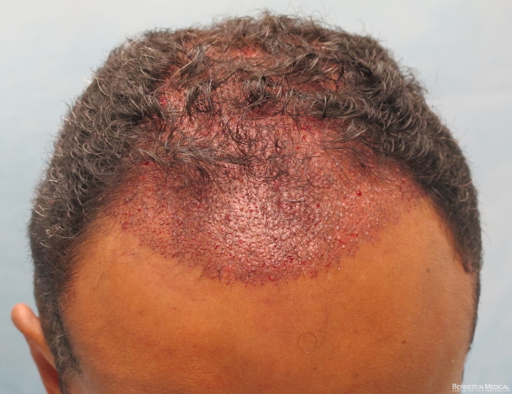 2b_distribution-of-2275-grafts_ijc.jpg