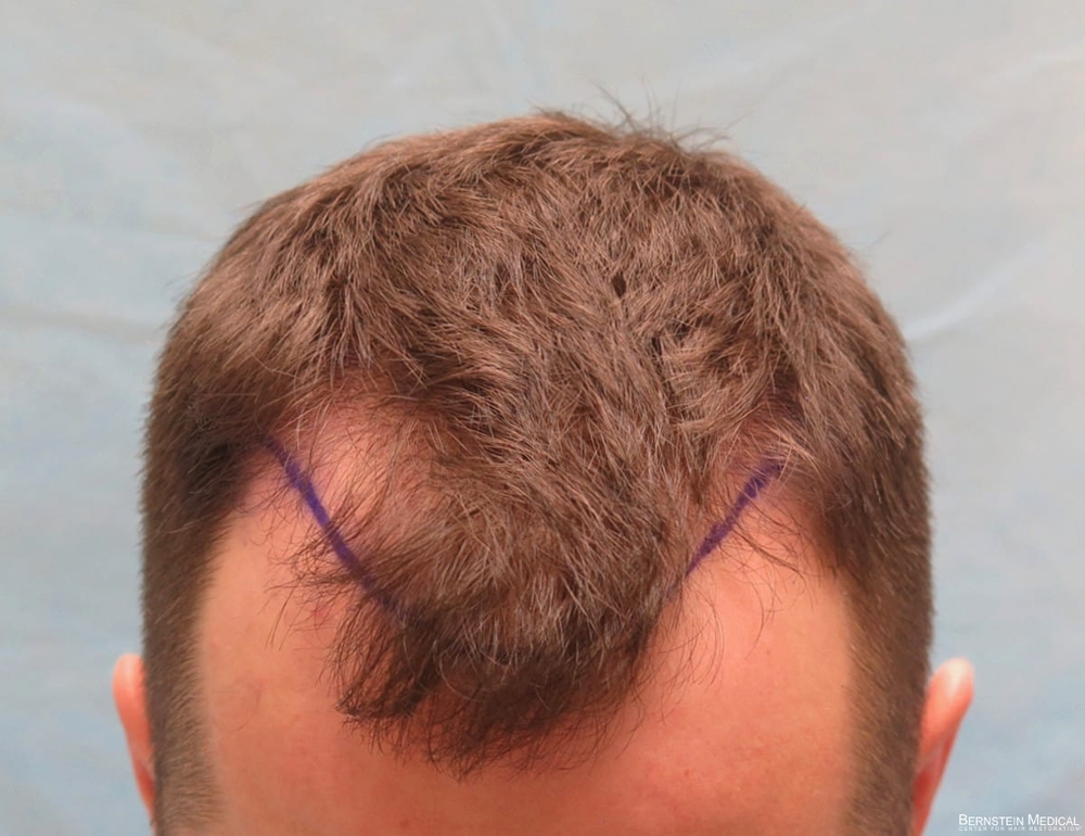 2b_plannd-hairline-top-view_kzk.jpg