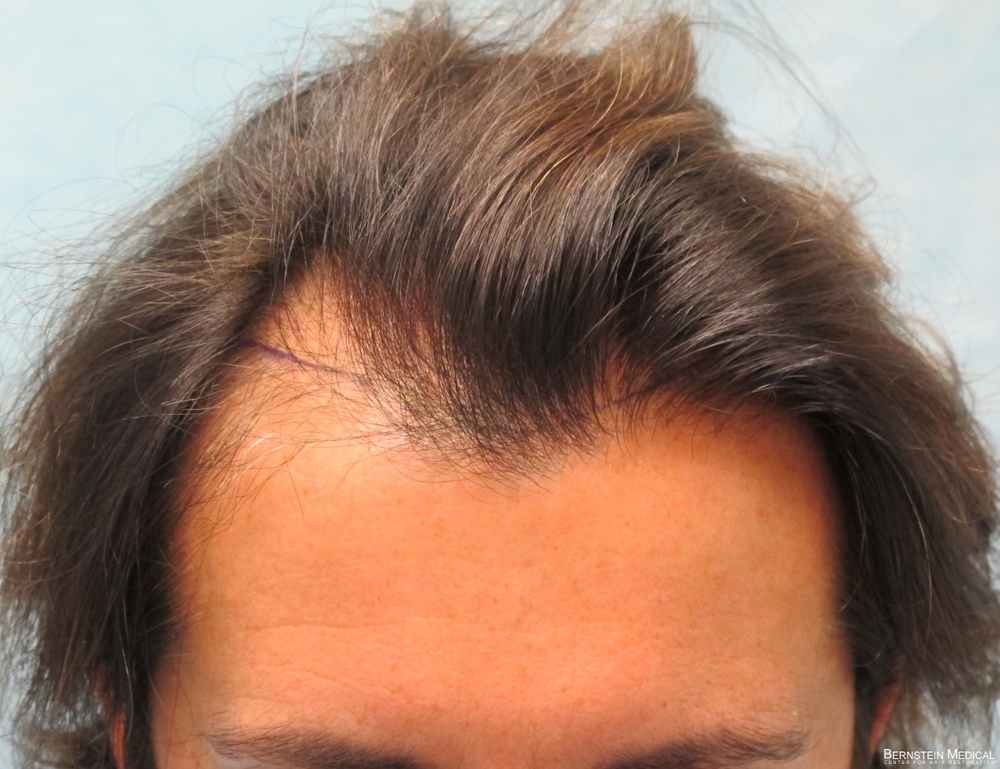 2b_position-of-hairline_top_odq.jpg