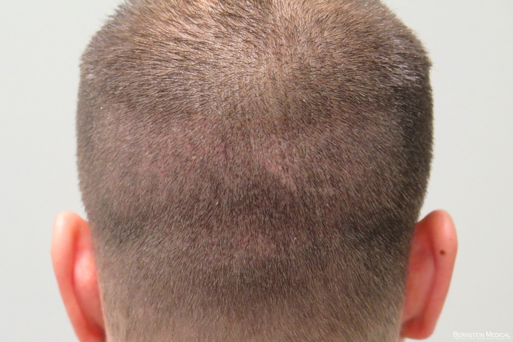 2c_11-days-post-op_rsi.jpg