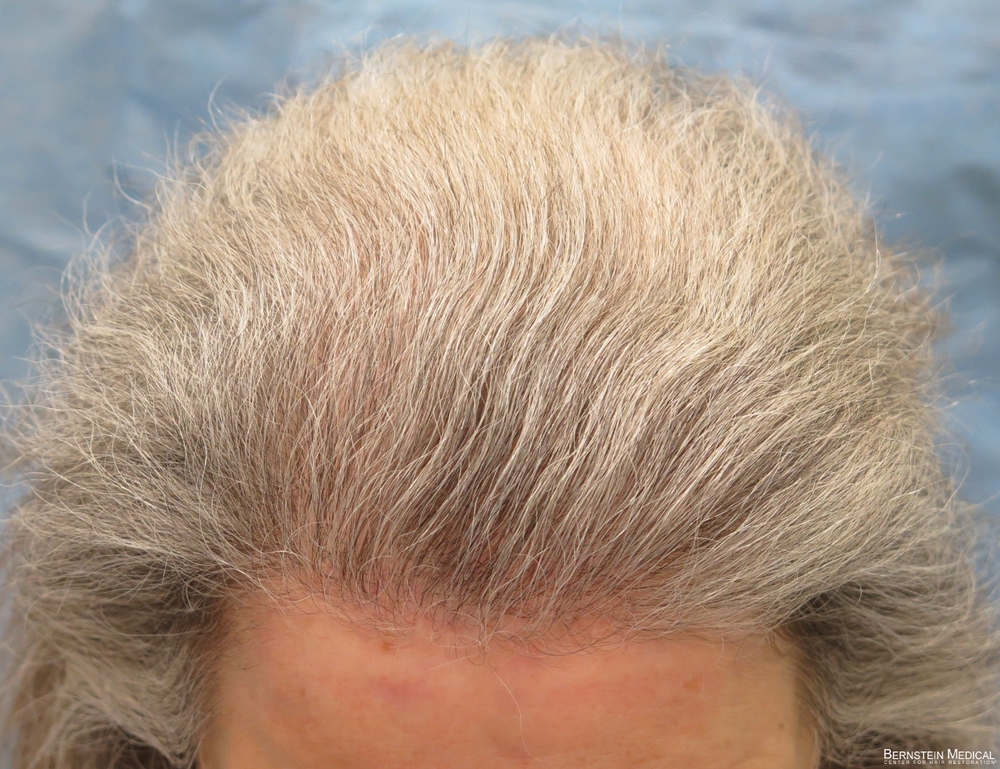 2c_after-hair-transplant_fpk.jpg