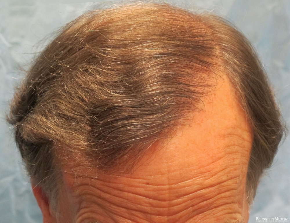 2c_after-transplant_top-view.jpg