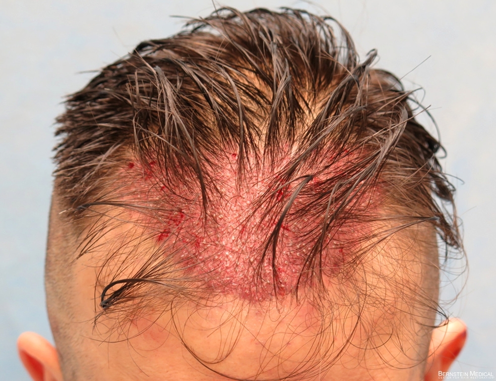 2c_grafts-placed-top-view_cfq.jpg