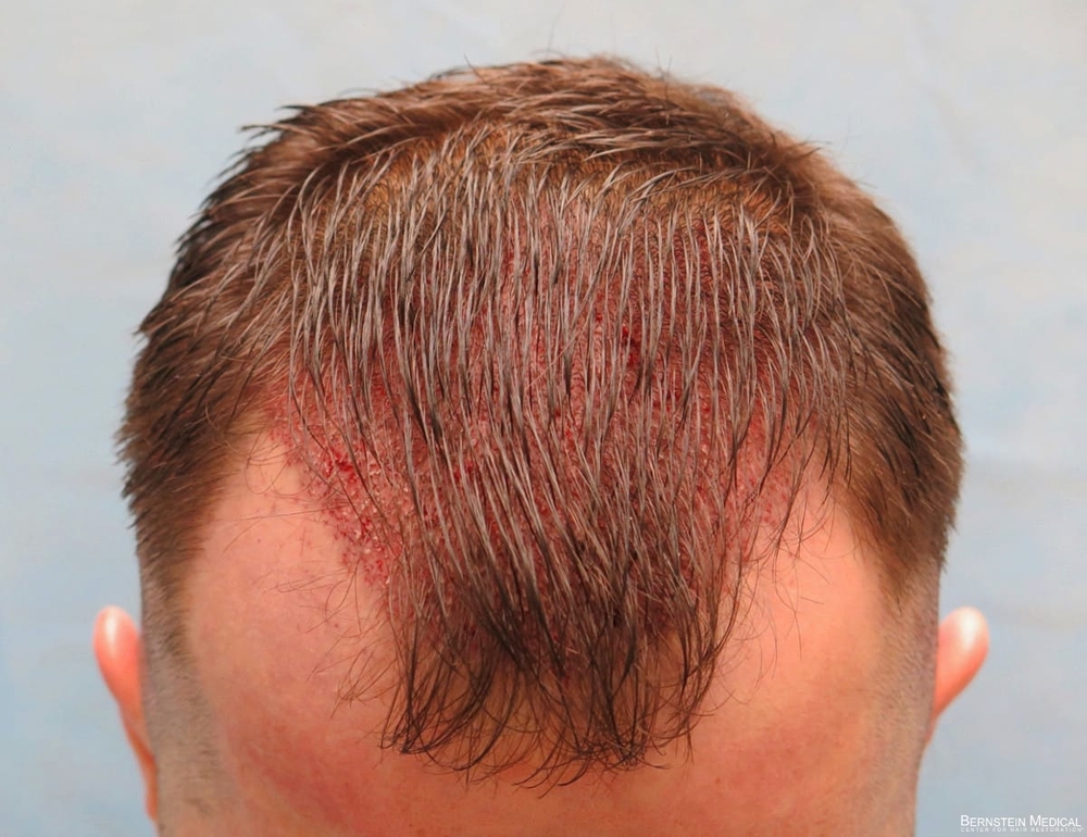 2c_grafts-placed-top-view_kzk.jpg