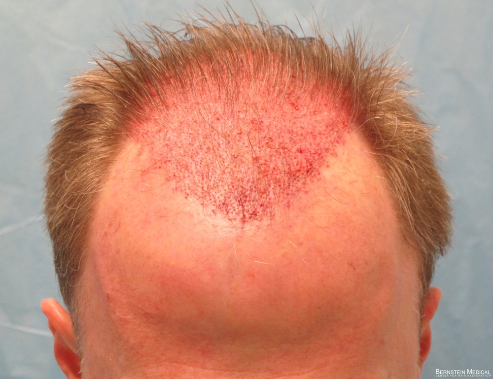 2c_placement-of-grafts-top-view_rfr.jpg