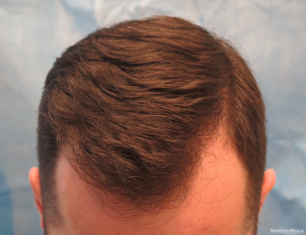2d_after-hair-transplant_kzk.jpg
