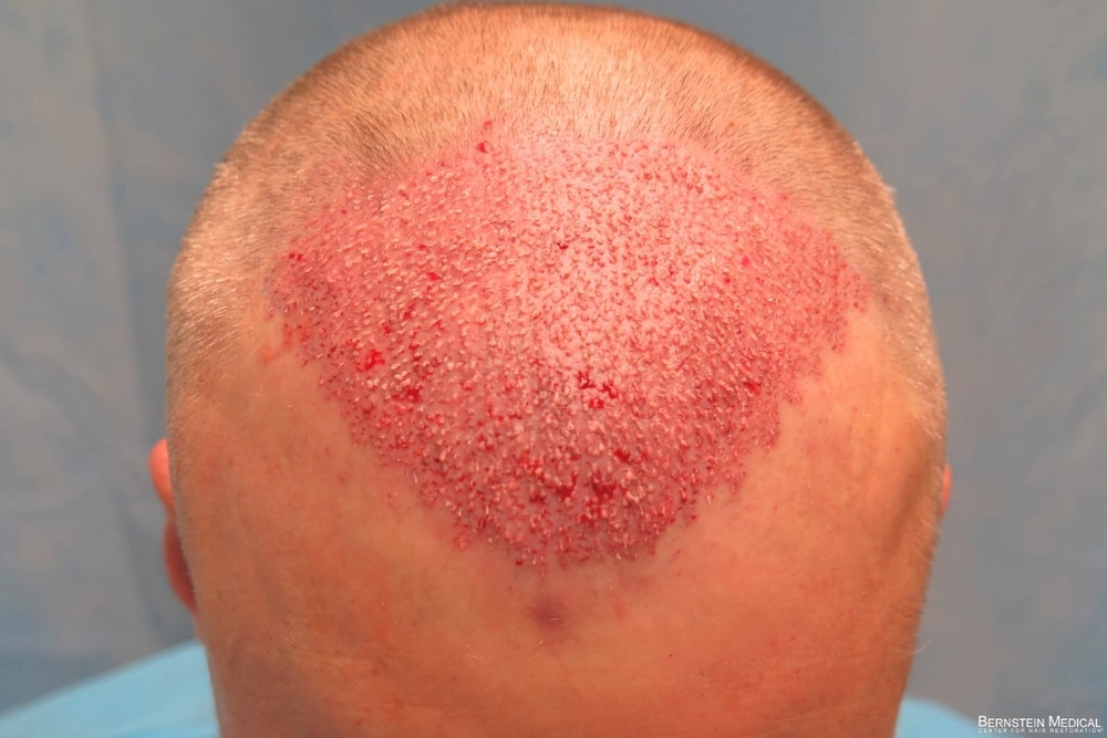 2d_grafts-placed_lki_1s.jpg
