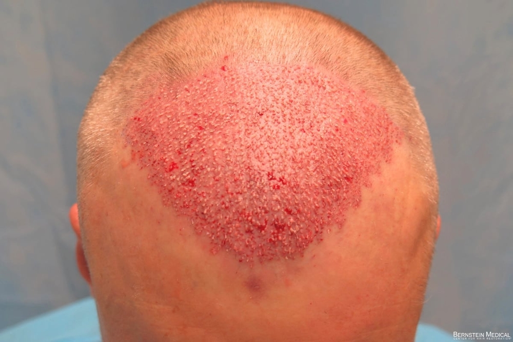 2d_grafts-placed_lki_1s.jpg