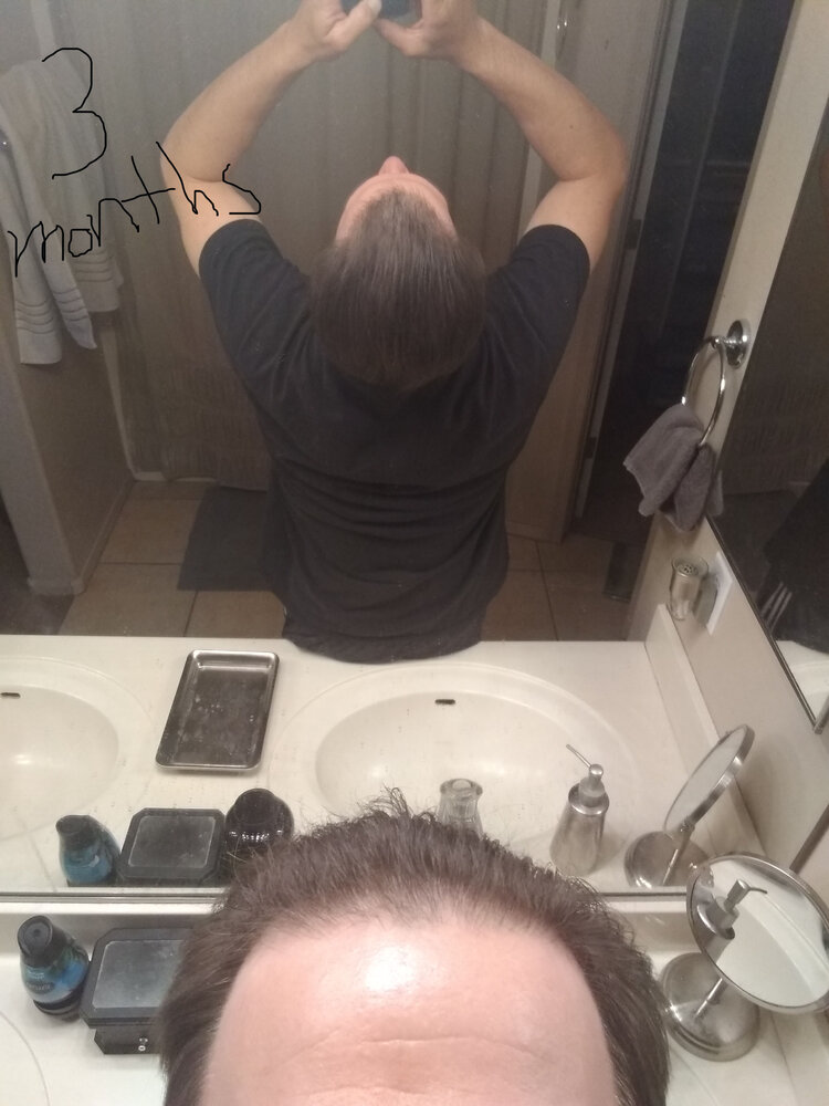 3 months finasteride.jpg
