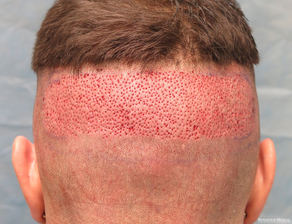 3a_donor-area-after-procedure_kzk.jpg