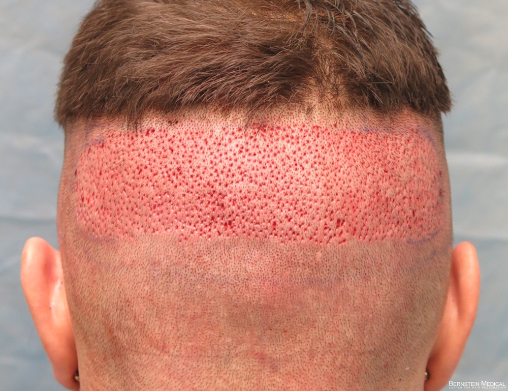 3a_donor-area-after-procedure_kzk.jpg