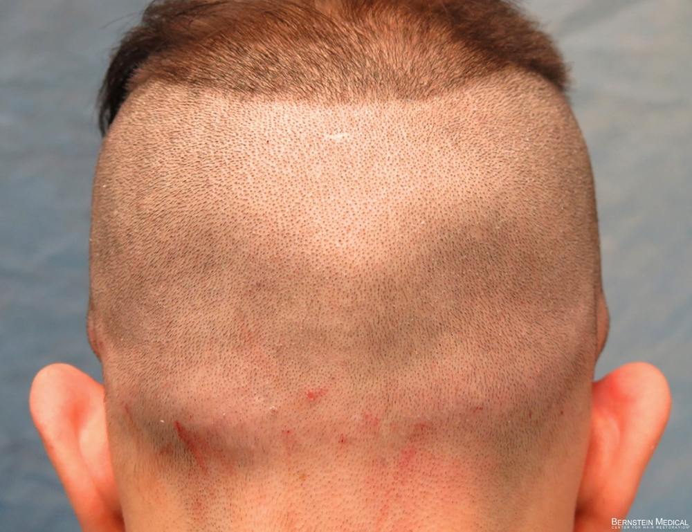 3a_donor-area-pre-op_cfq.jpg