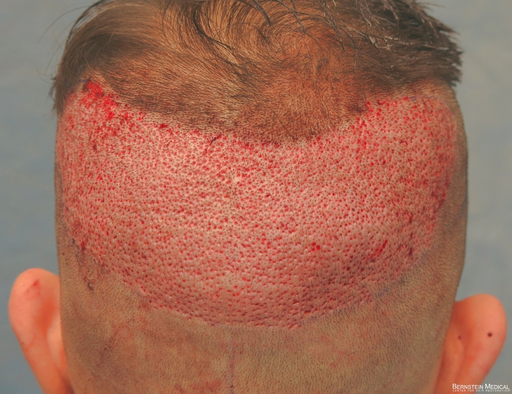 3b_donor-area-after-procedure_cfq.jpg