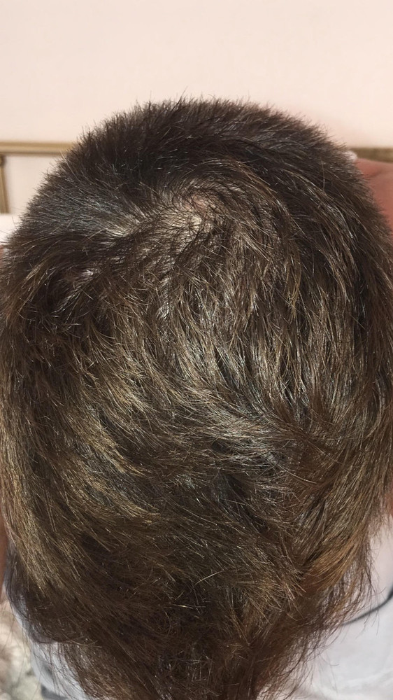4-months-topical-dutasteride.jpg