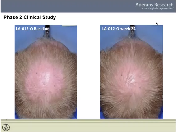 Aderans_Hair_Growth.png