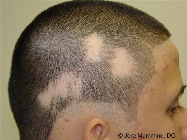 alopecia_areata_1_high.jpg