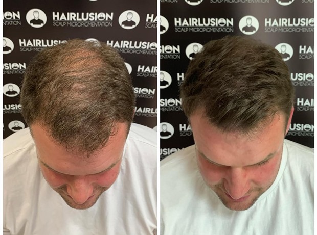 An-example-of-SMP-work-on-the-top-of-a-male-head.jpg