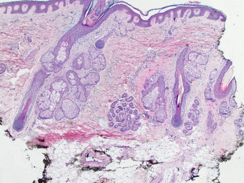 Androgenetic_alopecia_1_zpsff21571d.jpg