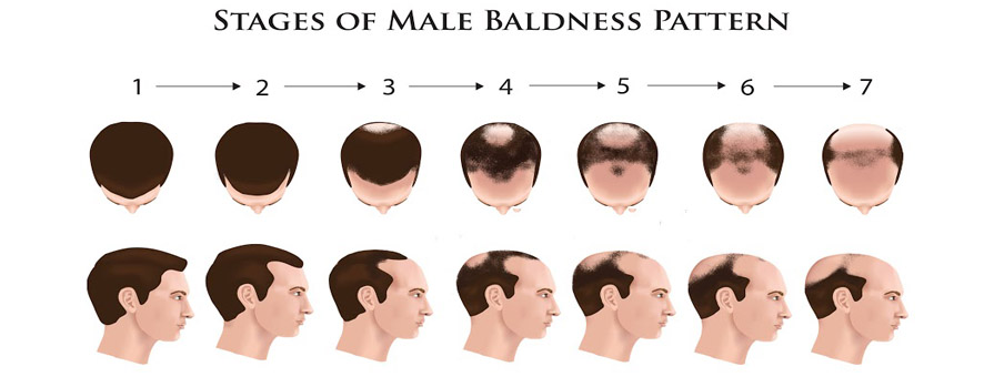 bald.jpg