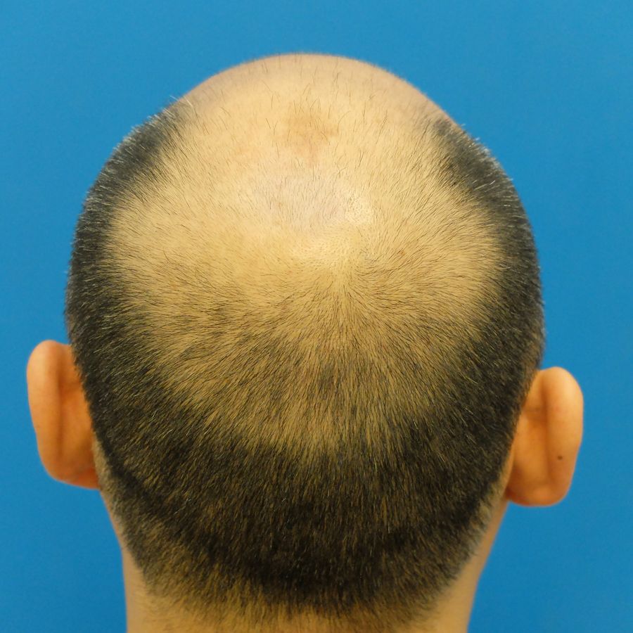 BEFORE-FINASTERIDE-GEL-2.5-1.jpg