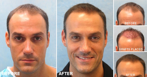 beforeafter_fb_acb.jpg