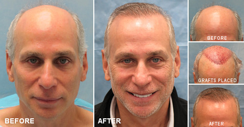 beforeafter_fb_FF_AVZ.jpg