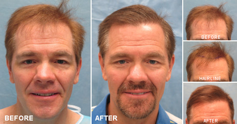 beforeafter_fb_FF_BEO.jpg