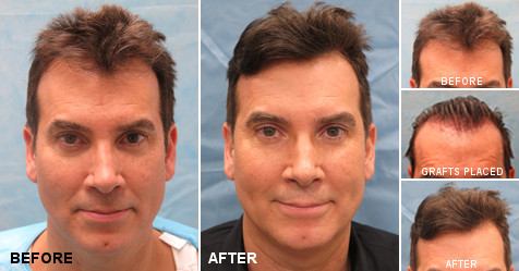 beforeafter_fb_FF_ESR%20(2).jpg