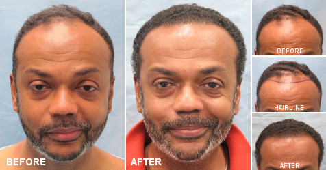 beforeafter_fb_FF_IJC.jpg