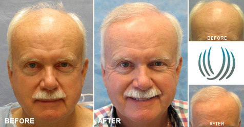 beforeafter_fb_FF_UTQ.jpg