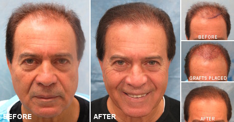 beforeafter_fb_hnz.jpg