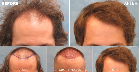 beforeafter_fb_rsi.jpg