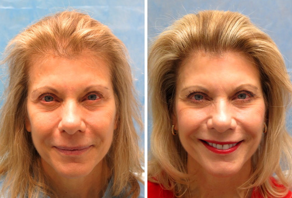 beforeafter_ff_gbe.jpg