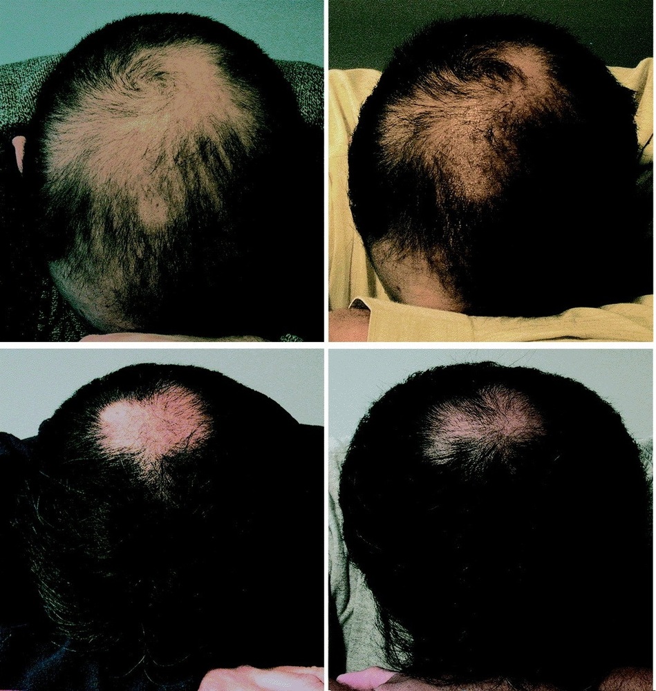 botox-study.jpg