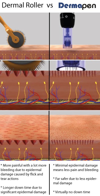 Dermapen-vs-Dermaroller.jpg