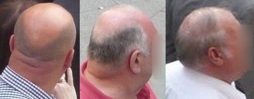 domed-skull-shape-hair-loss-link.jpg