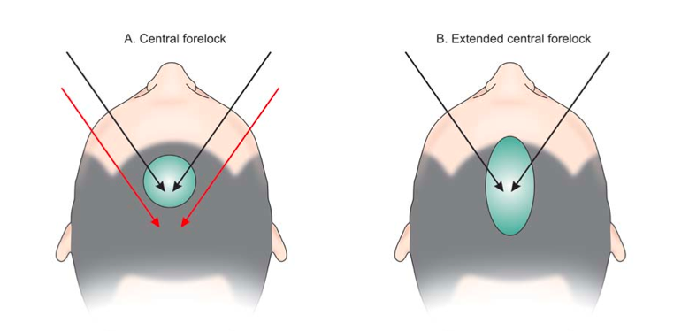 extended-central-forelock1.png